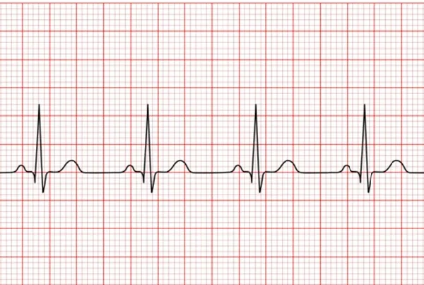 ECG